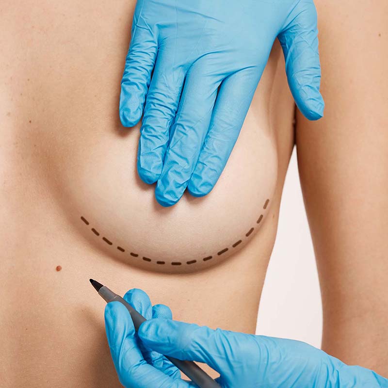 mama demarcada por médico